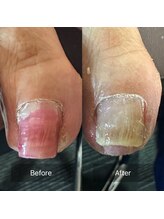 ぱんだ鍼灸接骨院 明里橋院/巻き爪施術一回目　