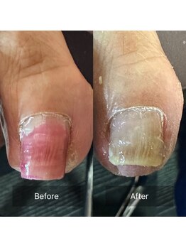 ぱんだ鍼灸接骨院 明里橋院/巻き爪施術一回目　