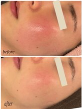 プレジール(Plaisir)/人気No.1ララピ-ル+LDM＋サーマ