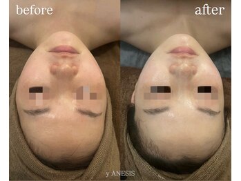 サロンワイアネシス(Salon y ANESIS)/ハーブピーリング×小顔コルギ