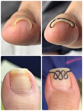 巻き爪矯正センター 沖縄 宜野湾/巻き爪矯正