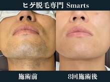 スマーツ(Smarts)
