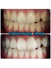 ホワイトニングショップ 武蔵小杉店/武蔵小杉ホワイトニング美白ケア