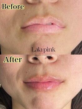 アクアカイロプラクティックの写真/【美白・ハリ・なめらか肌を目指す黒ずみケア】Lala pink【初回価格19800円】