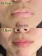 アクアカイロプラクティックの写真/【美白・ハリ・なめらか肌を目指す黒ずみケア】Lala pink【初回価格19800円】