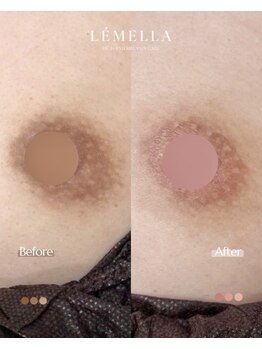 エルビービュティーサロン(LB BEAUTY SALON)/【ルメラ乳輪】実績数関西1★