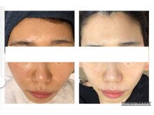 オアジスパ(Oasi Spa)/DTありハーブ３回