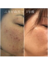 ビューティーサロン メイプルツリー/ドクターリセラ ADS肌改善1年
