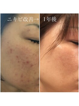 ビューティーサロン メイプルツリー/ドクターリセラ ADS肌改善1年