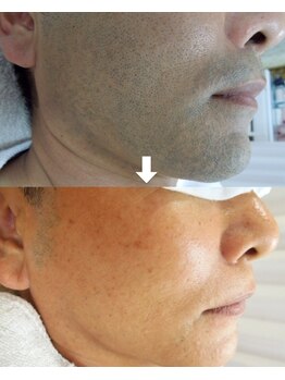 ミーシェ(Meshine)/ミーシェの最新ひげ脱毛機