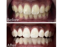 ホワイト 福岡天神店(WHITE)/ホワイトニングビフォーアフター