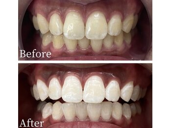 ホワイト 福岡天神店(WHITE)/ホワイトニングビフォーアフター