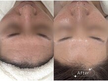 回数を重ねるごとに若々しく♪　(ハーブピーリング5回)