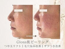 アネラボーテ(Anela Beaute)/Gloss肌ピーリング1回目