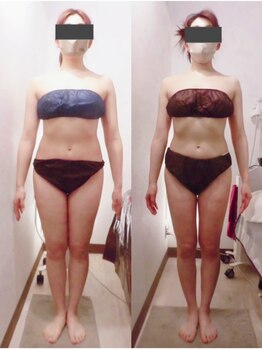 パルティール(PARTIR)/◆痩身　症例写真