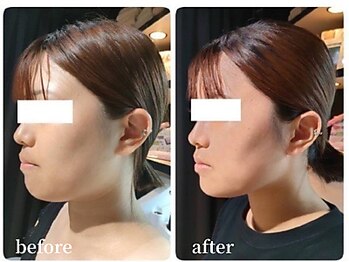 愛 まぁる/20代前半 アゴ下施 1回 2cc