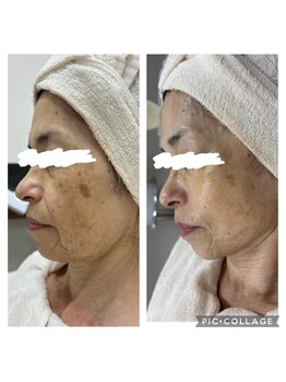 MTサロン 飯塚店/シミ、くすみの改善！