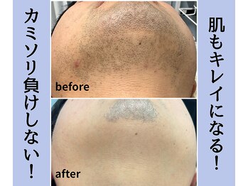 浜松富塚ベルミーランド/脱毛BEFORE→AFTER