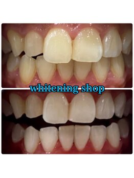 ホワイトニングショップ 武蔵小杉店/武蔵小杉ホワイトニング美白ケア