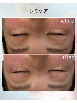 リンバー(Rinver)/シミケア Before・After