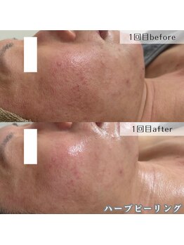 ネイルズビー 別邸(Nail's be)/花粉による肌荒れもお任せ下さい