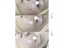 エヌエー 米子店(na)/肌質改善・毛穴レス
