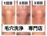 人気NO.2【毛穴汚れ＆開きの悩み】ハイドラ毛穴洗浄とエレクトロポレーション
