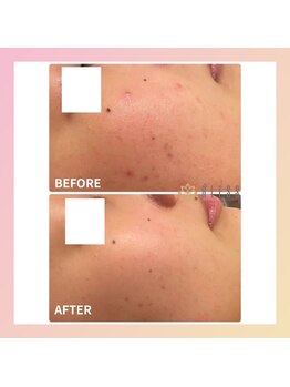 エステサロン ブレス 長町南店(BLESS)/ハーブピーリング結果