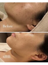 ルーヴェ(Luve)/陶肌トリートメント