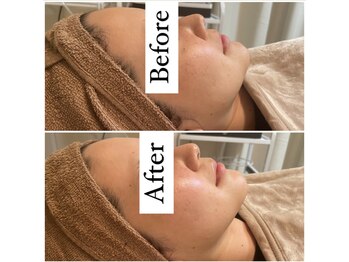 リリー 岐阜店(Lily)/小顔コース　Before After