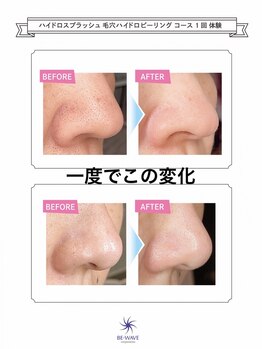ル シャの写真/毛穴の黒ずみ/ザラつき解消!毛穴洗浄×水素ケア小鼻・頬・耳裏まで洗浄し、毛穴がキュッと引き締まる実感◎