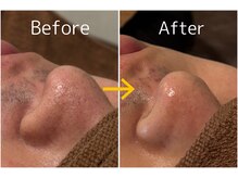 オアシスサカエ(OASIS SAKAE)/【髭脱毛＋毛穴洗浄】