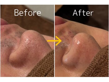 オアシスサカエ(OASIS SAKAE)/【髭脱毛+毛穴洗浄】