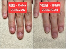 マニブルーム/初回と5回目　右手