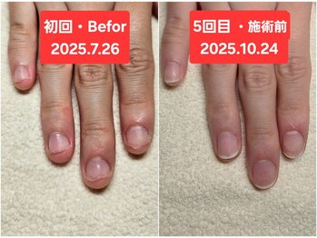 マニブルーム/初回と5回目　右手
