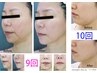 人気No.1 【小顔】脂肪・たるみ・シワ集中ケア!年齢に負けないハリ・艶60分