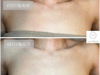 ラヴィオーラ 神戸兵庫店(La Viora)/ダイヤモンドハーブピーリング