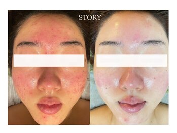 ストーリー(STORY)/ハーブピーリング専門店STORY