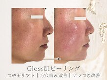 アネラボーテ(Anela Beaute)/Gloss肌ピーリング1回目
