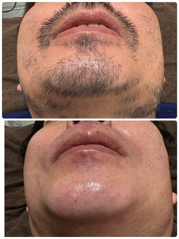 ピーナップ(P-nap)/50代メンズ髭脱毛