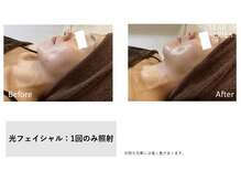 イル 名取店(iru)/光フェイシャル