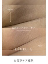 ジュエリーボディー(Jewelry body)/お尻下の黒ずみ！
