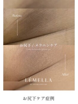 ジュエリーボディー(Jewelry body)/お尻下の黒ずみ！