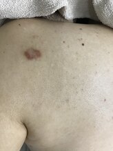 ナノハナ/鹿沼市の全身脱毛のナノハナ