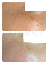 ティエラ(TIERRA)/シミケア3回