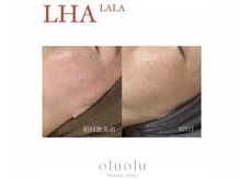 オルオル(oluolu)/LHALALA PEEL