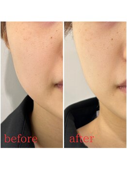 モアビューティー 紙屋町店/フェイスライン集中ケア!