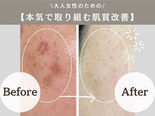 アンジュ(ANGE)の雰囲気（乾燥、毛穴、ごわつき、揺らぎ肌はお任せください♪）