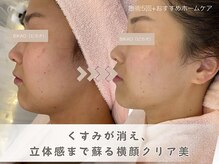 ビカオ(BIKAO)/ハーブピーリング