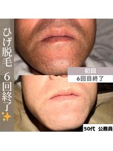 アカラビューティー(Akala Beauty)/ひげ脱毛〈６回終了！〉